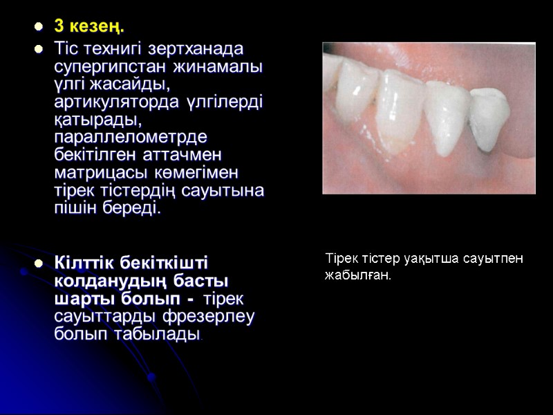 3 кезең.   Тiс технигi зертханада супергипстан жинамалы үлгi жасайды, артикуляторда үлгілерді қатырады,